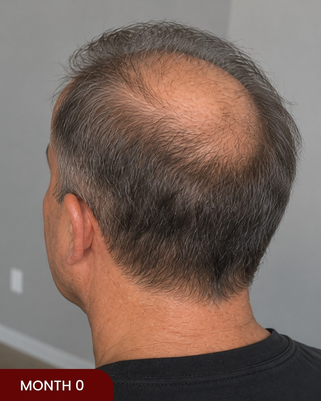 Before hair progress photo