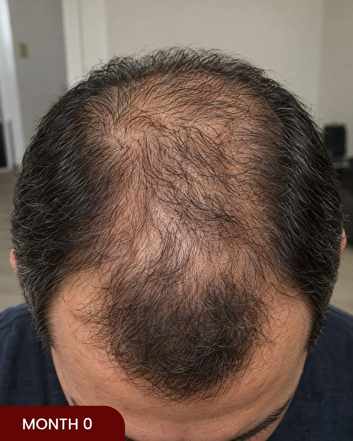 Before hair progress photo