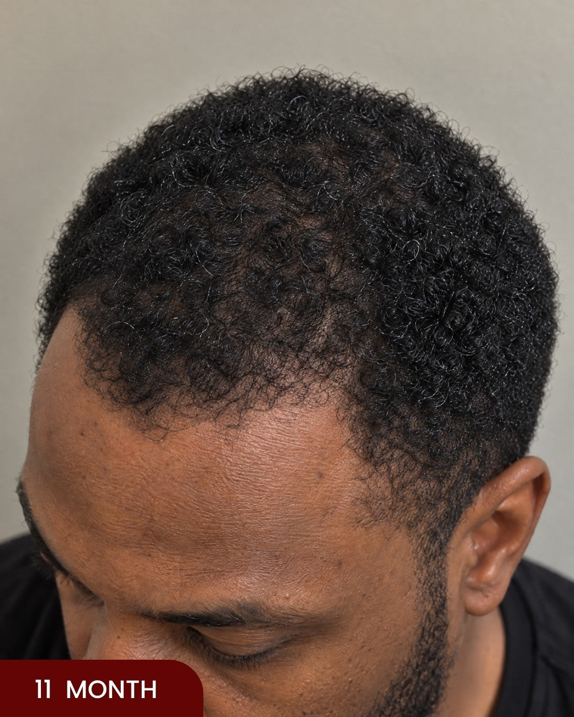 After hair progress photo
