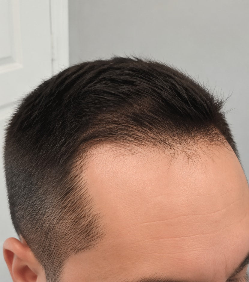 The same frontal hairline with a fuller appearance after consistent use