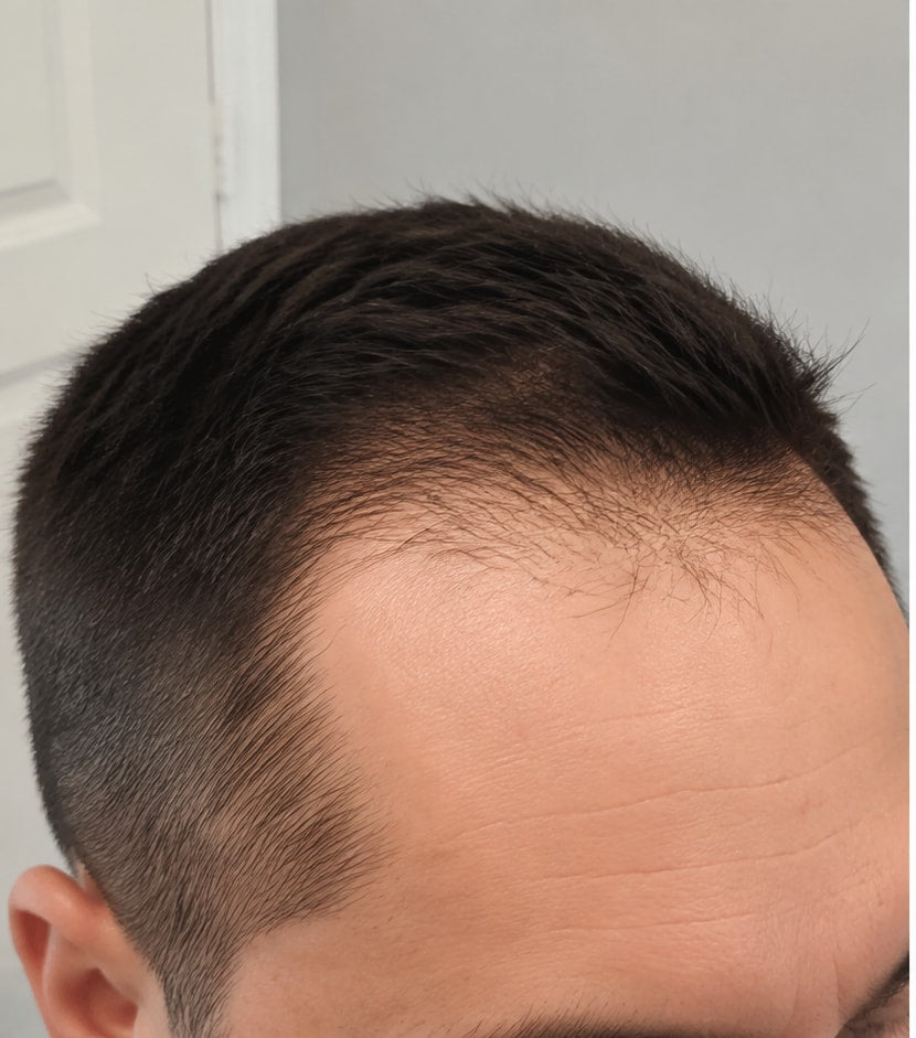 Frontal hairline before starting a consistent hair routine