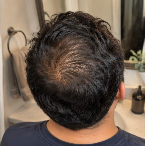 Carlos at-home hair progress, month 1