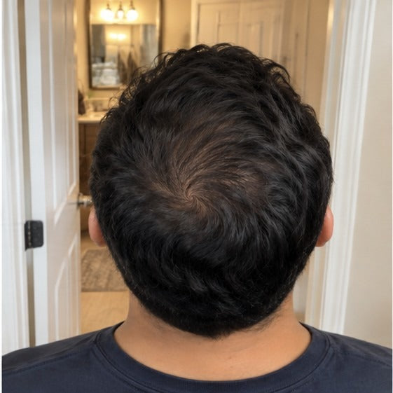 Carlos at-home hair progress, month 5