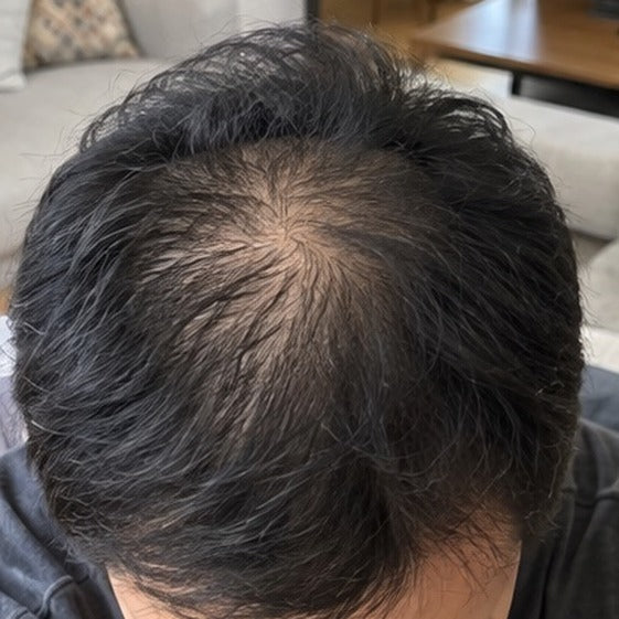 Kenji hair progress, month 0