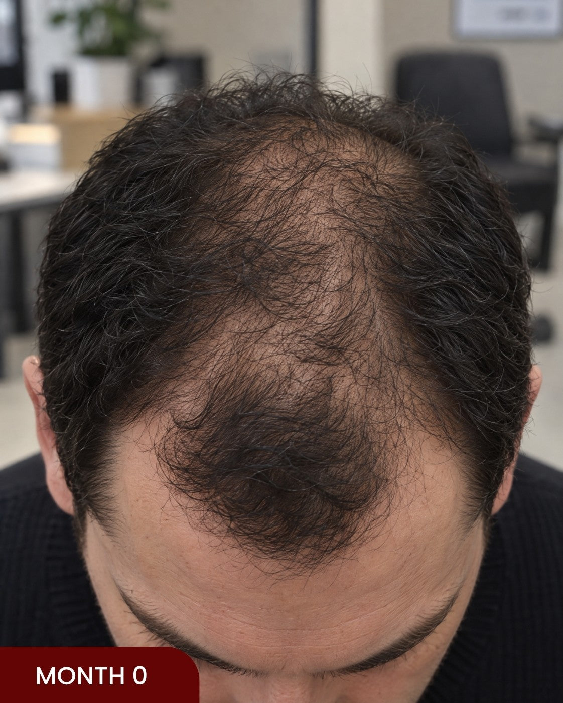 Before hair progress photo